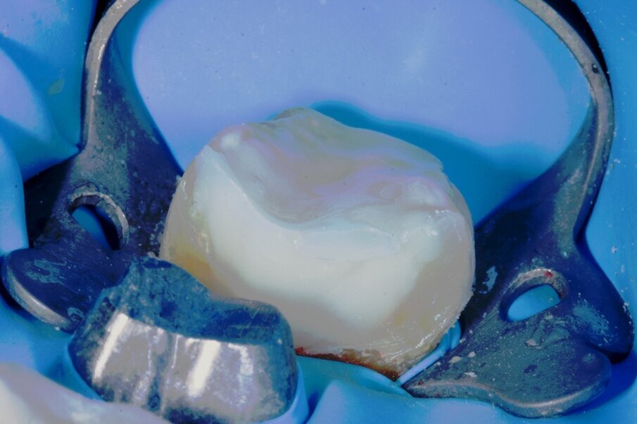 Figs. 5b: Direct restoration with everX Flow and Essentia.