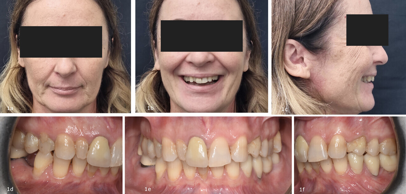 Figs. 1a–f: Initial situation. (a–c) Extra-oral and (d–f) intra-oral views. Extra-oral photos were taken with a smartphone through a dedicated App (Invisalign Practice App, Align Technology).