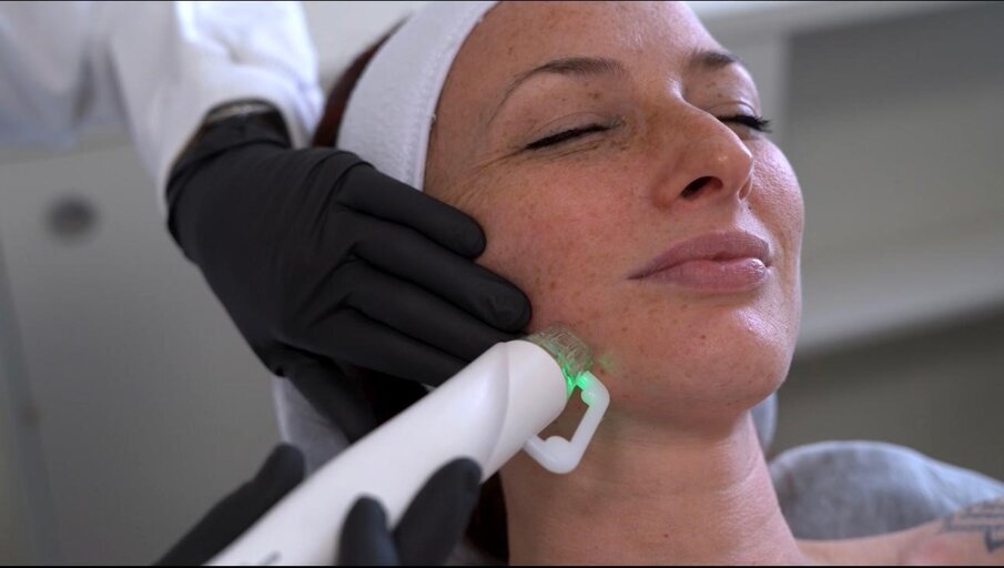 Fig. 4 - Trattamento di medicina estetica rigenerativa con tecnologia needling-diatermia.