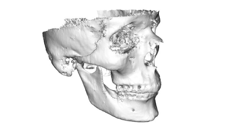 Fig. 4. Reconstrucción de un cráneo maya mediante adquisición de datos por CBCT.