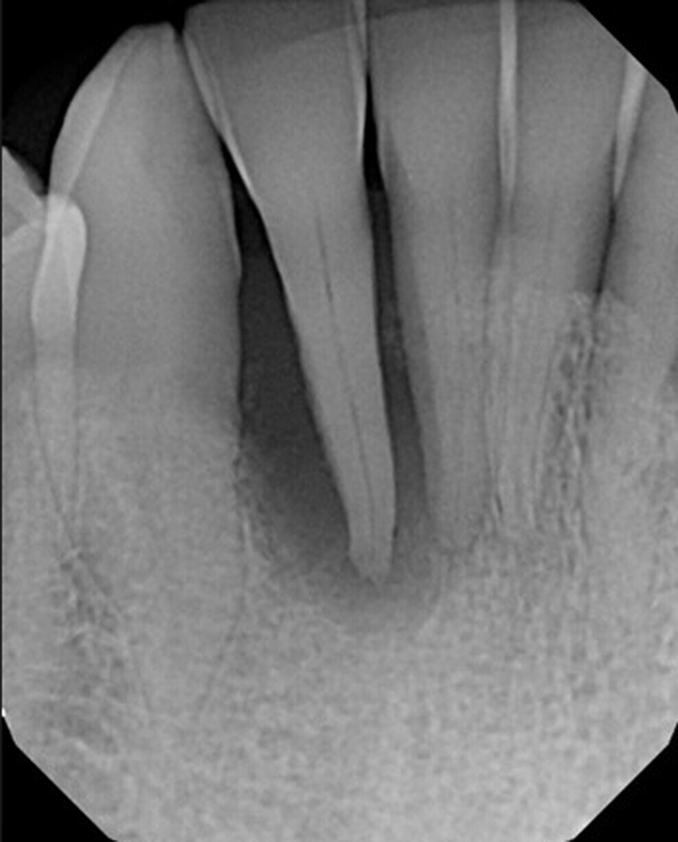 Fig. 1: Periapical radiograph of the maxillary anterior to evaluate the mobile tooth #42 and the adjacent dentition.