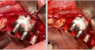 Cierre de comunicación oro-sinusal con placa de titanio personalizada 3D