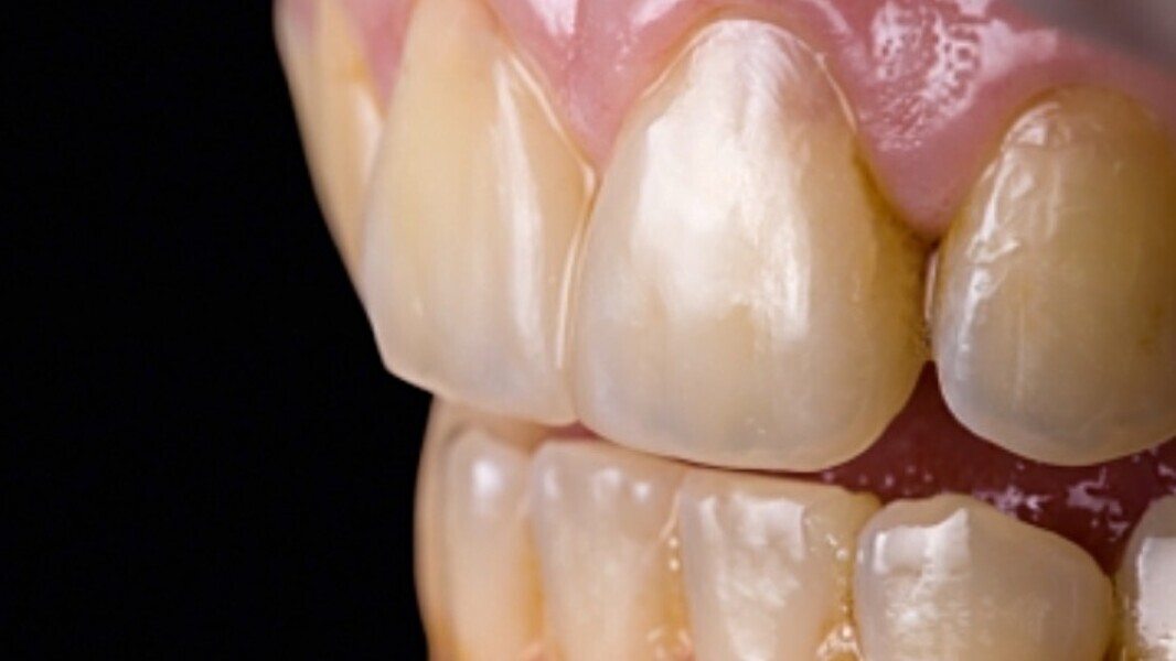 Fig. 7: También desde lateral se observaba una apariencia natural y sin transición.