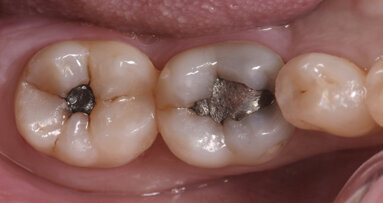 Amalgam replacement with flowable composite