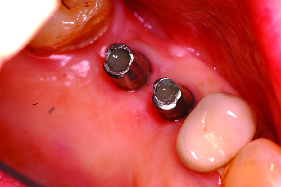 Figg. 13-15_Particolari dei monconi in titanio e delle corone in metallo ceramica.