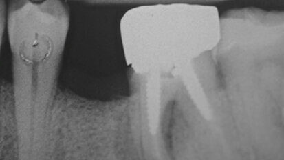 Guarigione di un alveolo post-estrattivo per seconda intenzione con membrana in pericardio equino