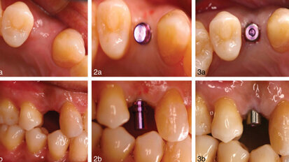 ‘WarLess’ procedure allows heart patients to continue anticoagulation therapy ‘WarLess’ procedure allows heart patients to continue anticoagulation therapy