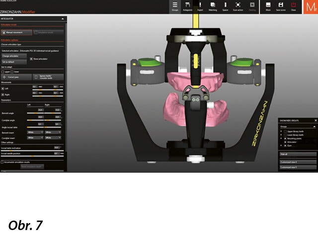 Přenesení situace do virtuálního artikulátoru a umístění jednotlivých rovin (pomocí funkcí „Generic“ a „Plaster“).