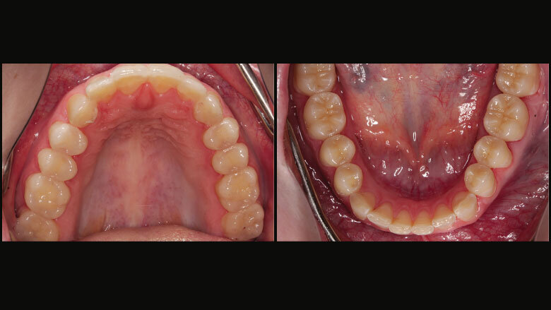 Figure 6: Upper and lower anterior teeth: lengthened with composite resin; upper posterior teeth with provisional restorations; lower posterior teeth with permanent partial crowns (characterized)