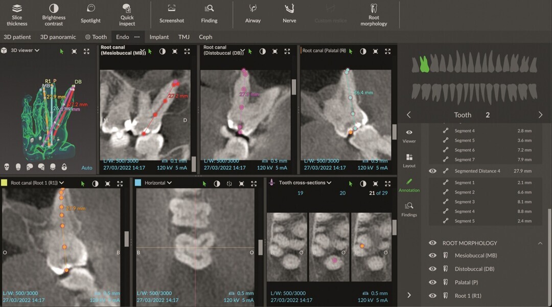 Fig. 3 : Mode endodontique dans DTX Studio Clinic traçant l’anatomie des canaux et indiquant une longueur de travail approximative en différentes couleurs pour chaque canal. Image montrant quatre racines distinctes.