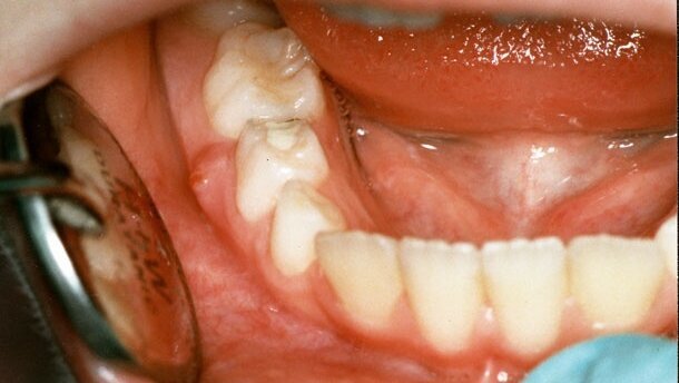 Milchzahnendodontie in der zahnärztlichen Allgemeinpraxis