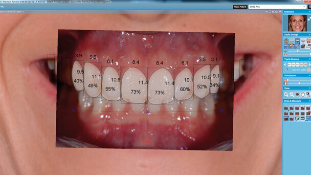 Applicazione di un software per smile design e CAD/CAM per la realizzazione del mock-up e dei restauri definitivi