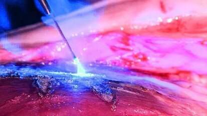 Markt voor lasertandheelkunde groeit gestaag