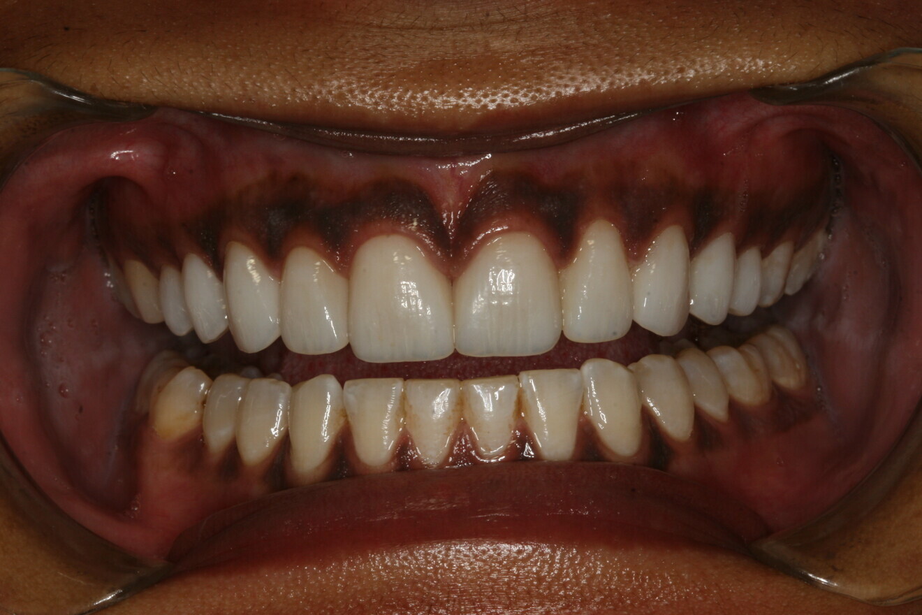  Fig. 9: Post-op retracted view.