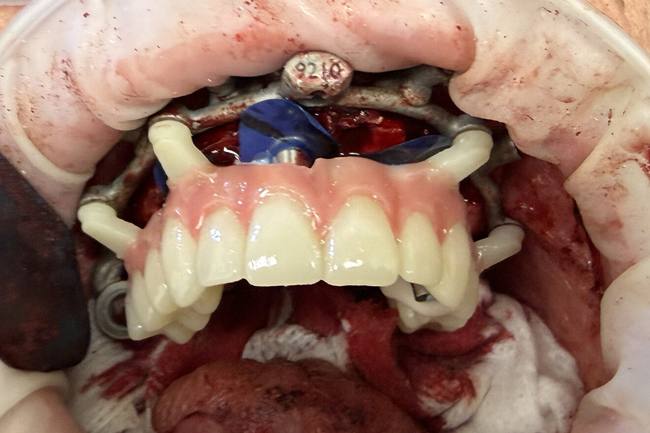 Fig. 22b: Retracted intra-oral facial view of the connection between the base frame and prosthesis.
