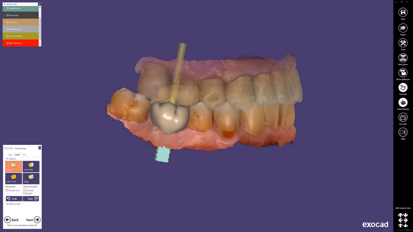 exocad – ChairsideCAD 2.3 Matera