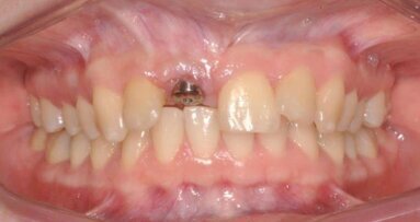 Odbudowa ubytku kostnego w szczęce allogennym blokiem kostnym z PRP