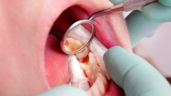 Европейските експерти се обединяват, за да спрат кариеса