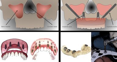 Carga inmediata o diferida en el maxilar totalmente edéntulo