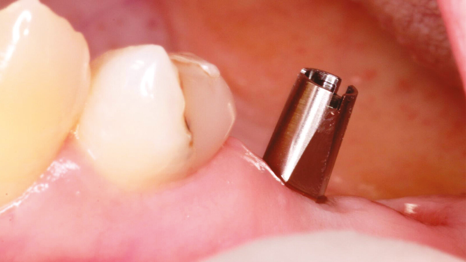 Achieving a higher standard in implant therapy for your patients