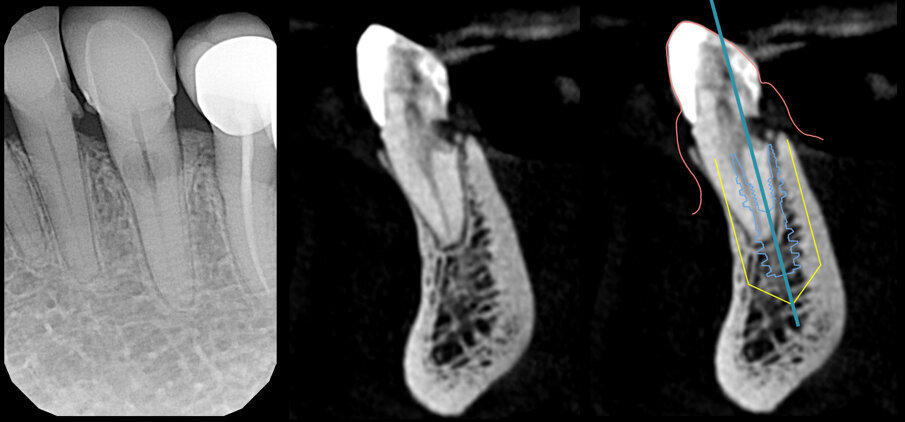 Fig. 4_Rx 2d e 3D, con evidenziazione del riassorbimento radicolare, che riguarda l’aspetto linguale e si approfondisce al di sotto del margine della corticale ossea; pianificazione implantare su apposito software di progettazione.