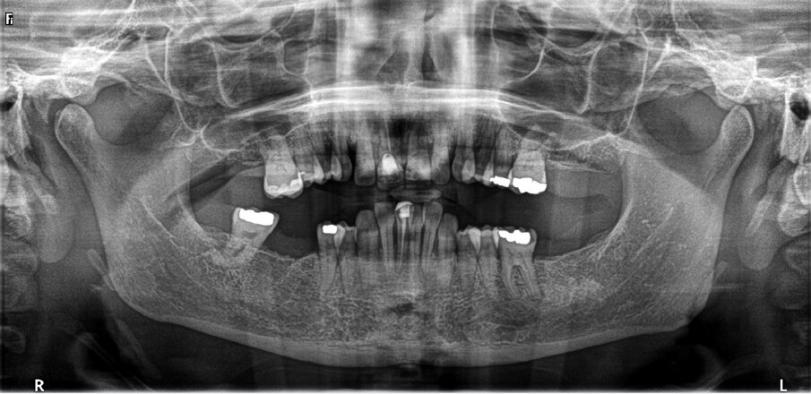 Fig. 3: Pre-op panoramic radiograph