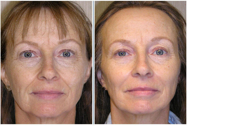 Figs. 7a & b: Before and after facial photographs.