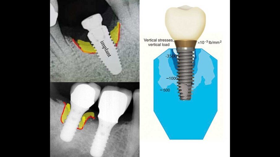 Fig. 13_Similutidine tra il riassorbimento osseo e l’andamento dello stress ottenuto con il FEM.