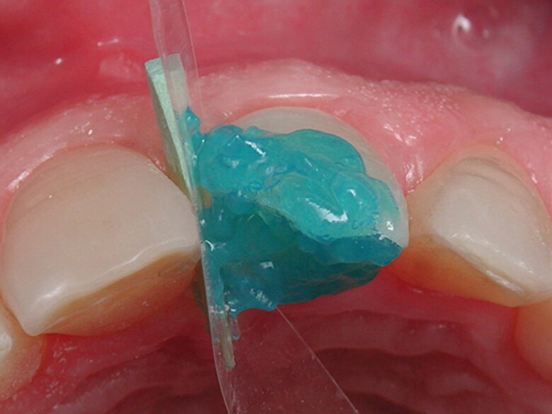 Figura 3. Grabando esmalte biselado con ácido forfórico al 37%. 