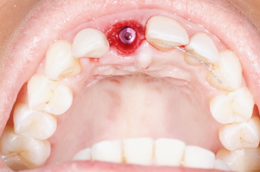 Fig. 13: Per-op clinical view showing the implant placed in the ideal position and the xenograft filling the gap and serving as a scaffold. 