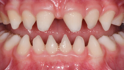 The use of 3D-printing technology for the prosthetic rehabilitation of a 3.5-year-old child with ectodermal dysplasia