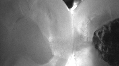 Webinar thematisiert röntgenfreie Kariesdiagnostik Webinar thematisiert röntgenfreie Kariesdiagnostik