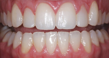 Alternative treatment options with nanohybrid composites