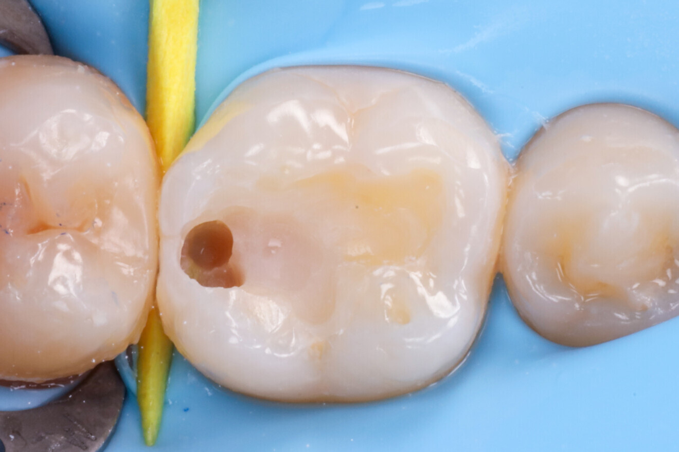 Fig. 4: Distal lesion becoming visible during composite removal.