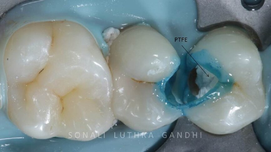 Figure 5 Selective Etching