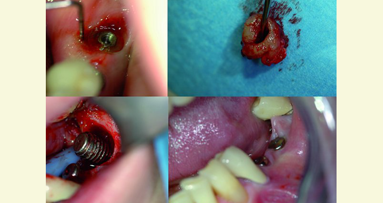 Implantologie et lasers