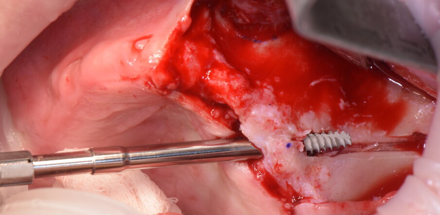 Figg. 20-23 - Impianto zigomatico AoN: notare la posizione extrasinusale con il mantenimento del picco osseo crestale.