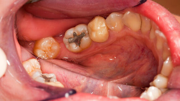 Europese Commissie adviseert verbod op tandheelkundig amalgaam