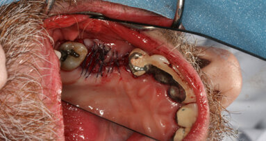 Patient’s own stem cells are harvested and transplanted into jaw