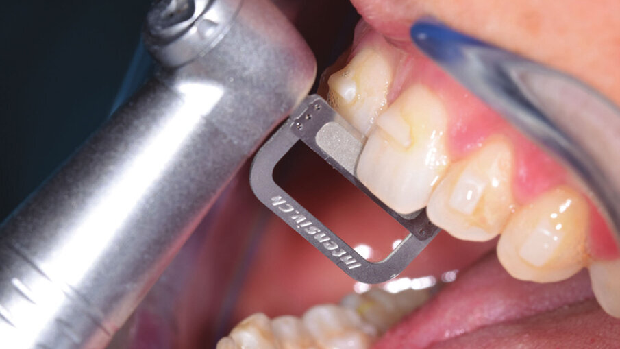 Figg. 7a-7e_Step intermedio. Lo stripping è stato eseguito con le nuove Orthostrips “Central” Intensiv. Una corretta procedura di riduzione interprossimale ci permette di recuperare spazio in arcata per ottenere la risoluzione completa dell’affollamento dentale e delle rotazioni presenti.