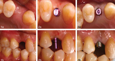 ‘WarLess’ procedure allows heart patients to continue anticoagulation therapy
