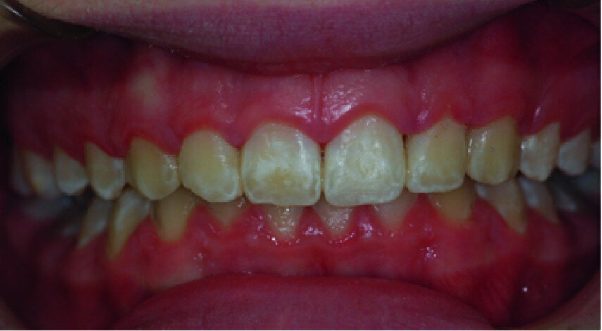 One month follow-up.