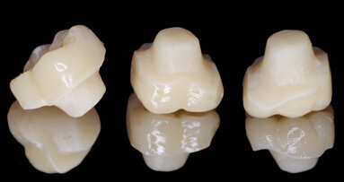Chairside fabrication of a nano-ceramic hybrid composite endocrown for a severely damaged molar after endodontic treatment Chairside fabrication of a nano-ceramic hybrid composite endocrown for a severely damaged molar after endodontic treatment