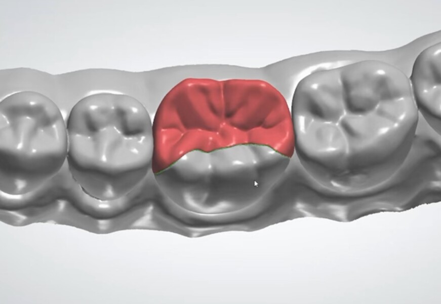 Fig. 15a: Digital design of the pinlay in 3Shape software: the occlusal view of the proposed restoration. 