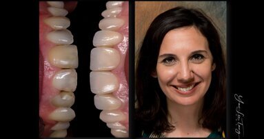 AMBER® MILL Lithiumdisilicaat – Freesblokjes met vrijheid in translucentie