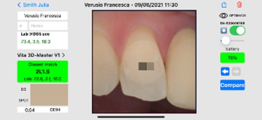 Fig. 16: Measurement of the shade of the maxillary lateral incisor.