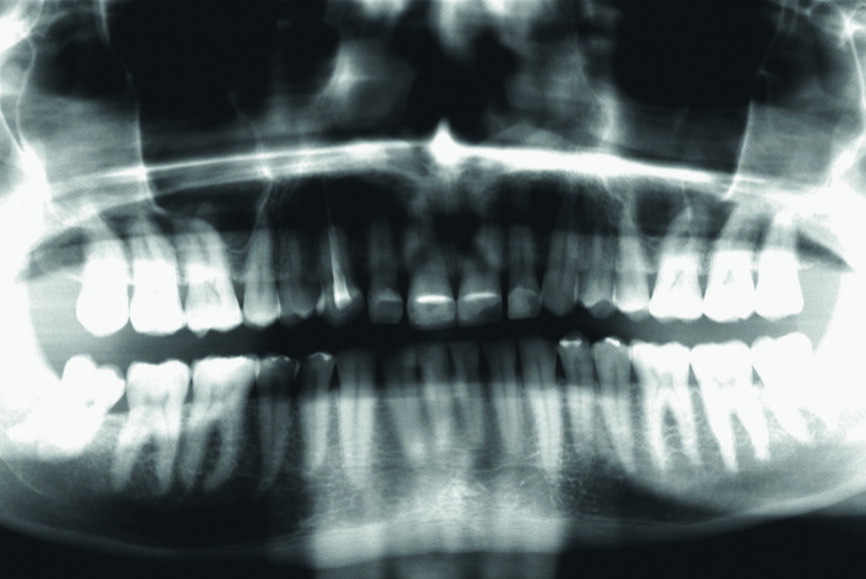 Fig. 4 : Situation initiale, radiographie panoramique (2015).