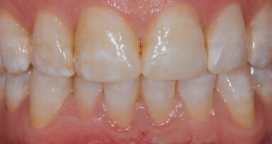 Remineralizacija: preventivni in terapevtski pristop pri nadzoru trdih tkiv