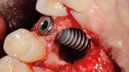 Inclusione canina e implantologia post-estrattiva immediata