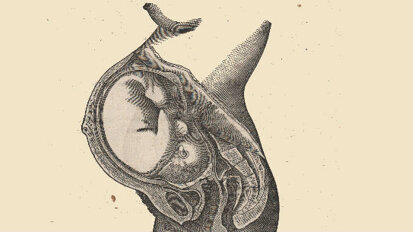 Prima rimozione di un cancro orale su un feto nell’utero
